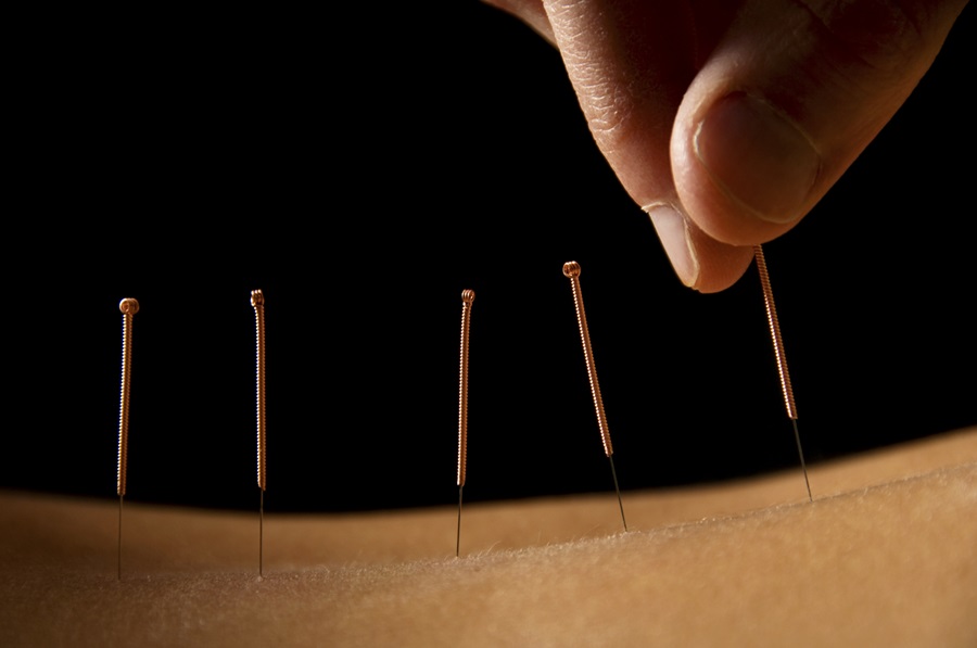 Close up of acupuncture needles being applied to skin