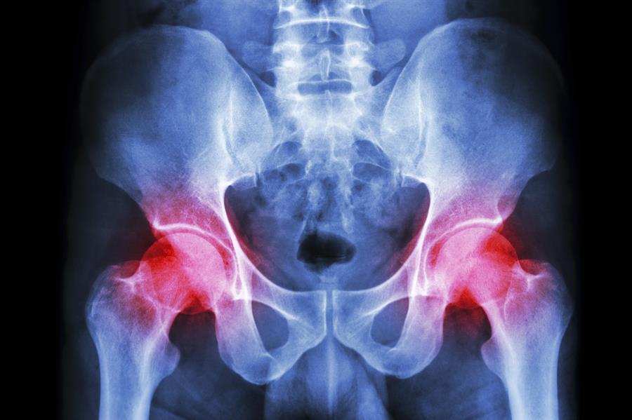 X-ray of hip joints with arthritis