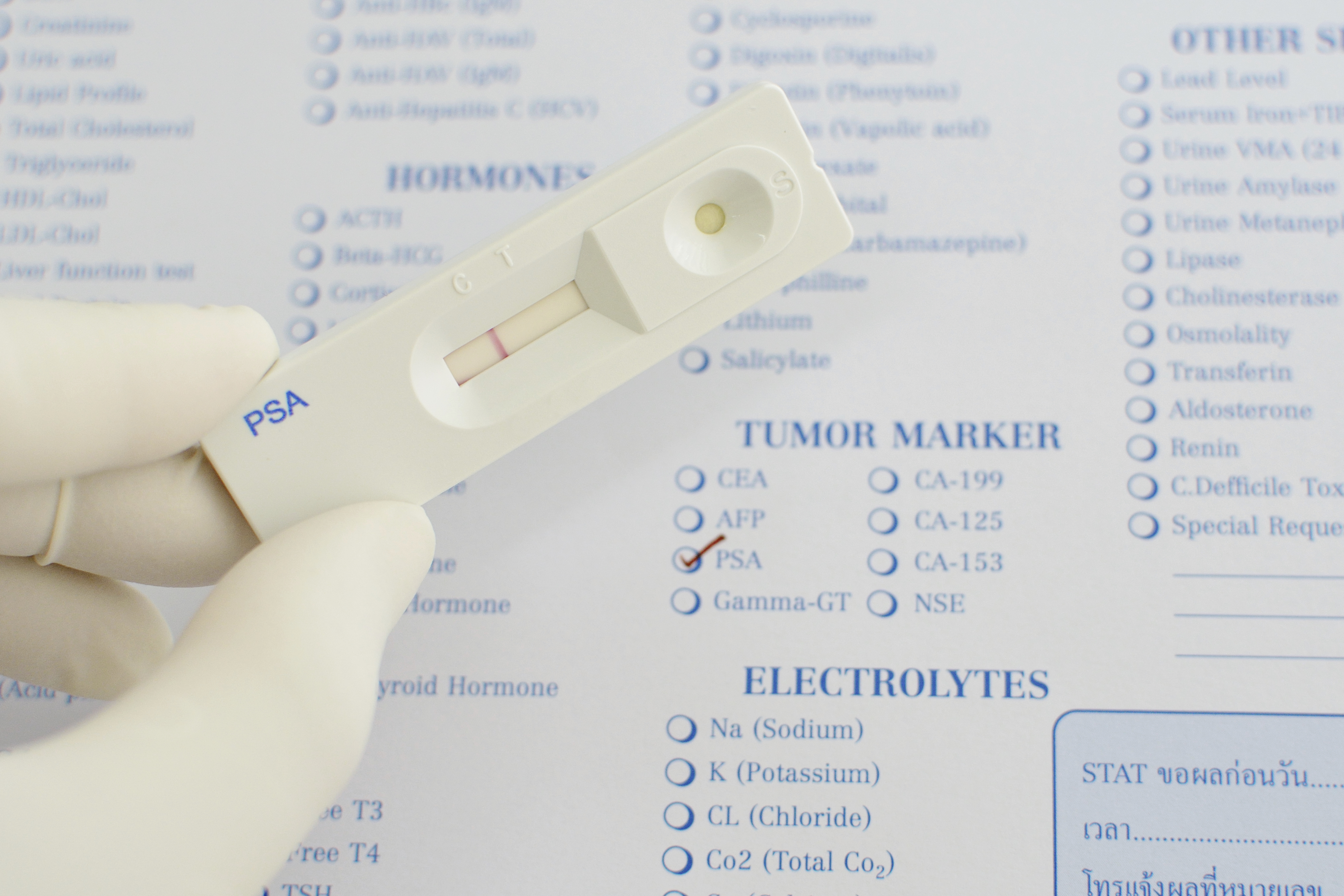 Le dépistage du cancer de la prostate : Ce que vous devez savoir au sujet du test de l’APS